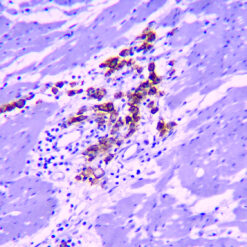Formalin fixed paraffin embedded human gastric carcinoma tissue stained with Claudin18.2.