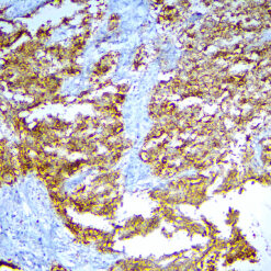 Formalin fixed paraffin embedded human gastric carcinoma tissue stained with Claudin18.2