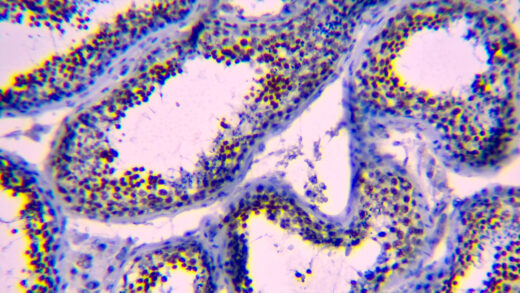 Formalin fixed paraffin embedded human testicular tissue stained with NUT1