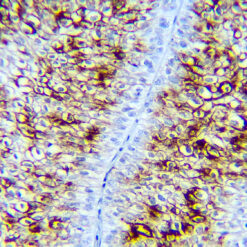 Formalin fixed paraffin embedded human urothelial carcinoma tissue stained with Uroplakin 3B