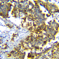 Formalin fixed paraffin embedded human urothelial carcinoma tissue stained with Uroplakin 3B