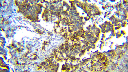 Formalin fixed paraffin embedded human urothelial carcinoma tissue stained with Uroplakin 3B